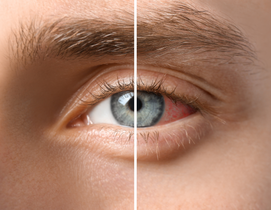Корисна інформація: Как выбрать капли от сухости глаз