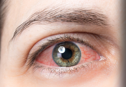 Корисна інформація: Как правильно провести диагностику синдрома “сухого глаза”?